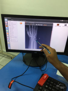 X ray of broken wrist - travelling in Galapagos | My Wandering Voyage travel blog